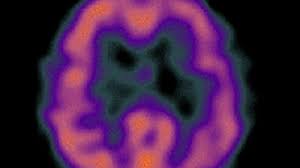 Cercetătorii au descoperit că, în cazul. Alzheimer Se Transmite Genetic Mobile