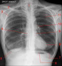 Rontgen Thorax