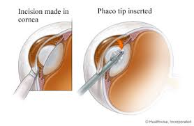 Image result for Cataract Extraction