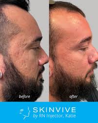 Skinvive for acne scaring 💧 The difference in his skin texture after one  double treatment is incredible! Skinvive is not a dermal filler, but a skin  booster. It is the first &