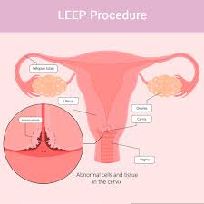 Medical illustration of cervical anatomy and procedures such as LEEP for abnormal cells