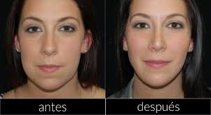 ¿qué hacer antes de una bichectomia? Bichectomia Antes Y Despues Abril 2021
