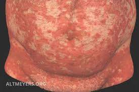 We did not find results for: Pityriasis Rubra Pilaris Overview Altmeyers Encyclopedia Department Dermatology