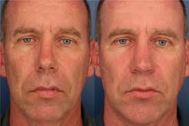Rhinoplasty Before and After Photos by Ronald Schuster, MD; Lutherville, MD 