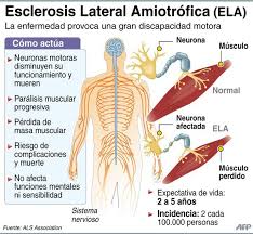 Es una enfermedad neuromuscular de progresión rápida, que lleva a la perdida de la fuerza muscular generalizada, que incluye los músculos respiratorios, músculos para deglutir los alimentos y los músculos del habla. Gran Avance En El Conocimiento De La Ela Esclerosis Lateral Amiotrofica Biologia Molecular