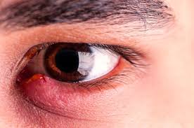 Styes Chalazia On Eyelids Skin Care Pimples Stye Treatment Eye Stye Remedies