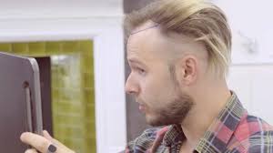 Sandy's hair transplant results