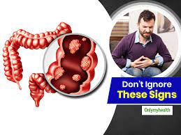 Colon cancer symptoms and treatment. World Cancer Day 2021 Young Men Should Not Ignore These Symptoms Of Colon Cancer