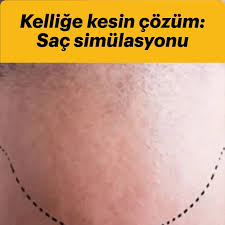 Sac Dokulmesinde Yeni Tedavi Yontemi Sac Simulasyonu Sac Guzellik Sac Dokulmesi