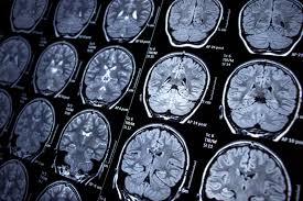 Image result for Brain Lesion