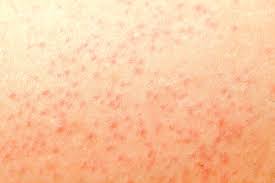 bolinhas no corpo principais causas e tratamento