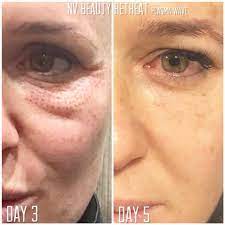Nv Beauty Retreat Plasma Fibroblasts Under Eye Facebook
