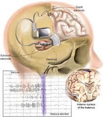 Image result for Thalamic Stimulation
