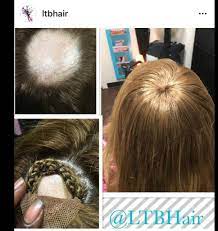 In men, hair often begins to recede at the hairline on the forehead. Non Surgical Hair Restoration Phoenix Hair Loss Specialist Ltbhair