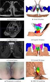 Image result for Perirectal Abscess