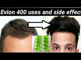 How To Use Vitamin E Capsule For Hairgrowth Skin And Health Evion 400 Uses Evion 400 Vitamine E Youtube Can i take evion 400 for hair growth? how to use vitamin e capsule for hairgrowth skin and health evion 400 uses evion 400 vitamine e