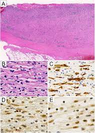 bap1 immunohistochemistry and p16 fish results in combination provide higher confidence in malignant pleural mesothelioma diagnosis: A Combination Of Mtap And Bap1 Immunohistochemistry Is Effective For Distinguishing Sarcomatoid Mesothelioma From Fibrous Pleuritis Lung Cancer