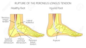 Check spelling or type a new query. Vector Illustration Of Peroneal Tendon Injuries Rupture Of The Peroneus Longus Tendon Lateral Ankle Injury Royalty Free Cliparts Vectors And Stock Illustration Image 91000972