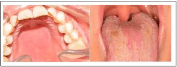 Image result for oral thrush symptoms roof of the mouth