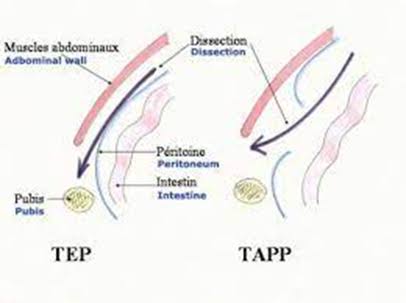 Abordaje Anatómico: Tep (Extraperitoneal) Vs. Tapp (Transabdominal), Generada Por Ia