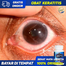 Check spelling or type a new query. Obat Keratitis Radang Kornea Mata Sehat Mata Limatta Shopee Indonesia