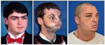 13 Before And After Photos Of People Who Had Facial Transplants