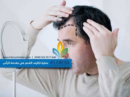 عملية تكثيف الشعر في مقدمة الرأس وكيفية زراعة الشعر في الرأس مركز فلوريا Florya