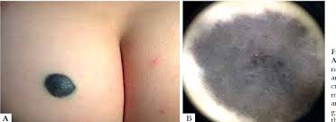 Image result for Blue Nevus