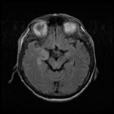 Herpes simplex encephalitis (hse) is an inflammation of the brain parenchyma, typically in the medial temporal lobe, that is caused by either herpes simplex it is the most common cause of fatal sporadic encephalitis in the us. Herpes Simplex Encephalitis Radiology Reference Article Radiopaedia Org