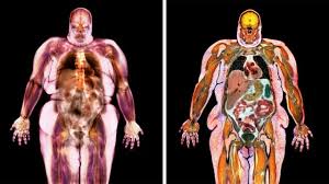 Image result for Obesity