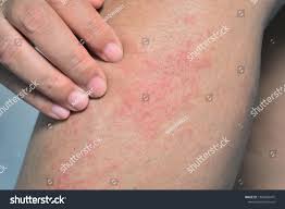Image result for allergy rash on the legs