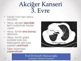 3 Evre Akciger Kanseri Ucuncu Evrede Teshis Tedavi Yasam Suresi