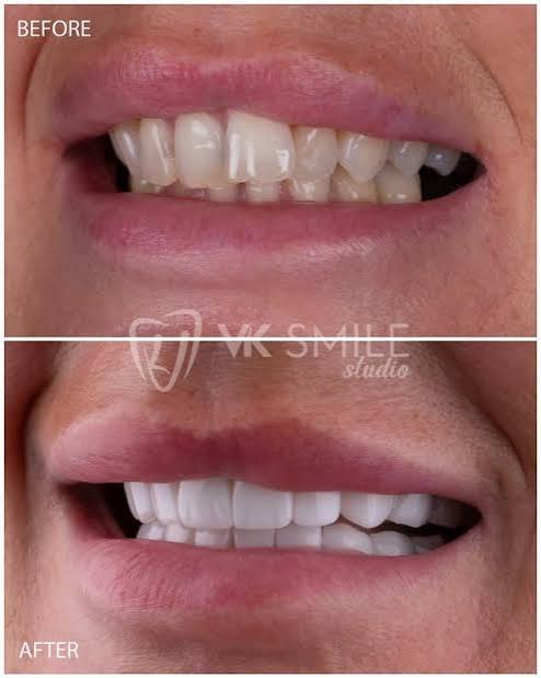Smile Makeover Using Crowns & Veneers Turkey | VK Smile Studio