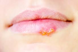 Lippen sind die häufigste und auffälligste lokalisation von herpetischen eruptionen. Herpes Simplex Mit Homoopathie Behandeln Experto De