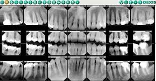 Dental X Rays How To Tell If You Have A Cavity Fridley Mn