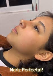 •Les presentamos este antes y después de #Rinomodelacion con ácido  hialurónico. A veces pequeños detalles bastan para lograr grandes cambios,  que no solo transforman la apariencia, sino, la confianza ...