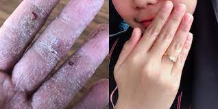 Pasti anda akan berputus asa kerana penawar penyakit ini masih lagi anda belum ditemui. Tangan Busuk Sampai Isi Kulit Saya Nampak Derita Ekzema Gadis Ini Berakhir Setelah Dapatkan Rawatan