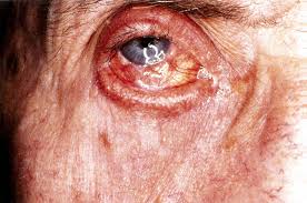 Image result for Conjunctivitis Resources