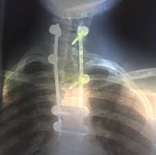 Princess eugenie, who suffered from scoliosis as a child, is now the royal patron of the scoliosis. Caras Eugenie Fala Da Cirurgia A Coluna A Que Foi Submetida Aos 12 Anos