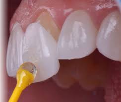 Diş minesi temizlemenin bir diğer doğal yolu portakal kabuğu. Lamine Dis Kimlere Yapilir Dentnis Estetik Dis Klinigi