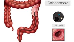 Despre durerile din partea stanga a abdomenului burtii in functie de localizarea durerilor abdominale sunt durerile din hipocondrul stang stanga sus in aceasta zona fiind localizate urmatoarele organe. Cand Colonoscopia Arata Ca Ai Diverticuloza Hemoroizi Sau Ambele Reginamaria Ro
