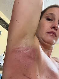 This is under my arm Pitt this is what Radiation do it cooks you from the  inside to the out it look way better now it was worse so I had to