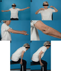 Image result for Elbow Extension Test