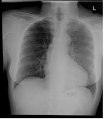 Grid Cutoff Radiology Reference Article Radiopaedia Org