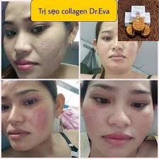 Cao sẹo collagen