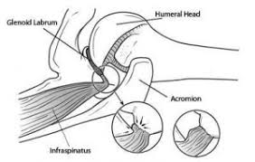What Is Shoulder Impingement Syndrome Is Impingement Normal Or Not