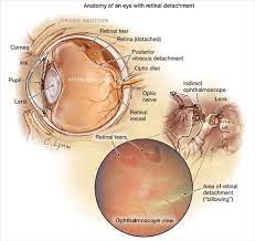 Retinal Detachment Retina Surgery Eye Sight Improvement Eye Health