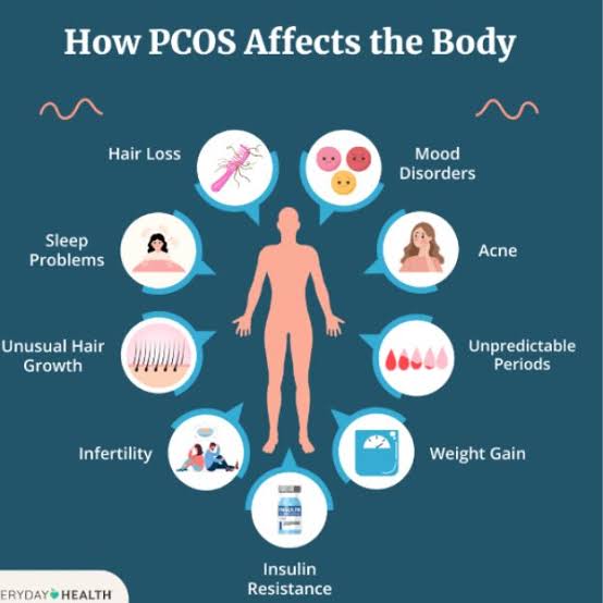 تأثيرات متلازمة تكيس المبايض (PCOS) على الجسم، من إنشاء الذكاء الاصطناعي