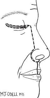 Check spelling or type a new query. Partial And Total Maxillectomy Ento Key