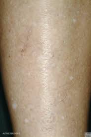 Hypomelanosis Guttata Altmeyers Enzyklopadie Fachbereich Dermatologie
